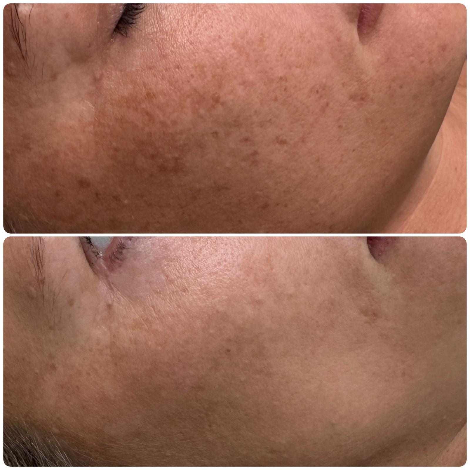 Before and after — Pigmentation