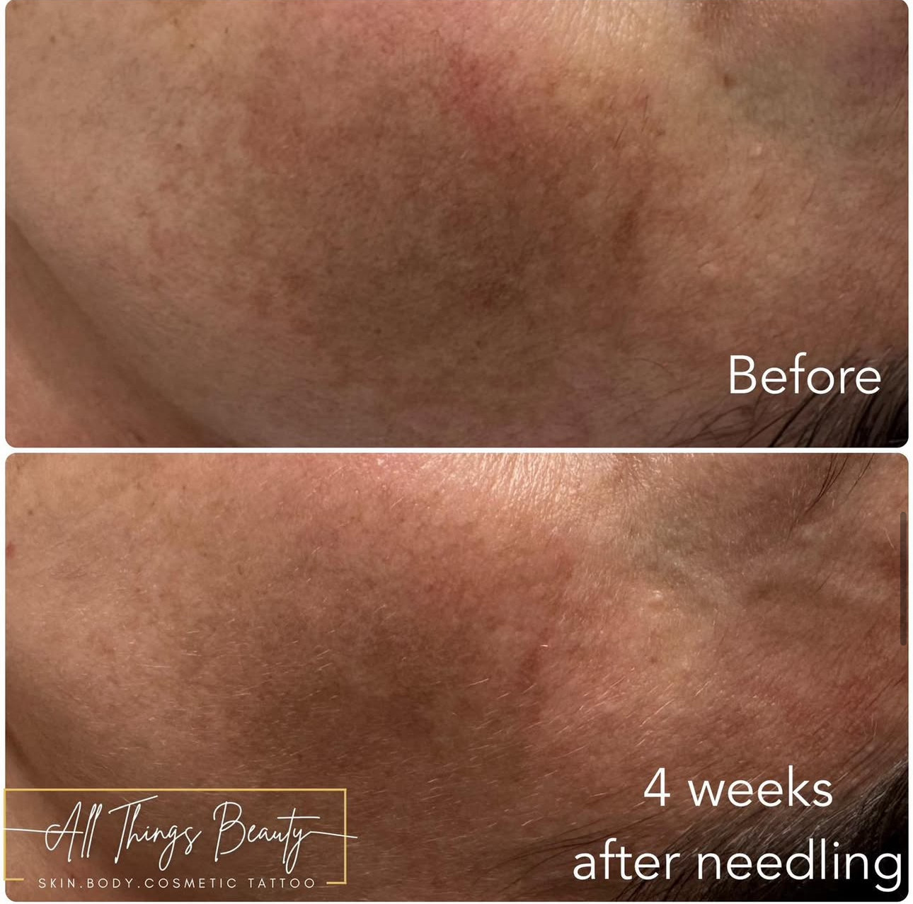 Before and after — Texture
