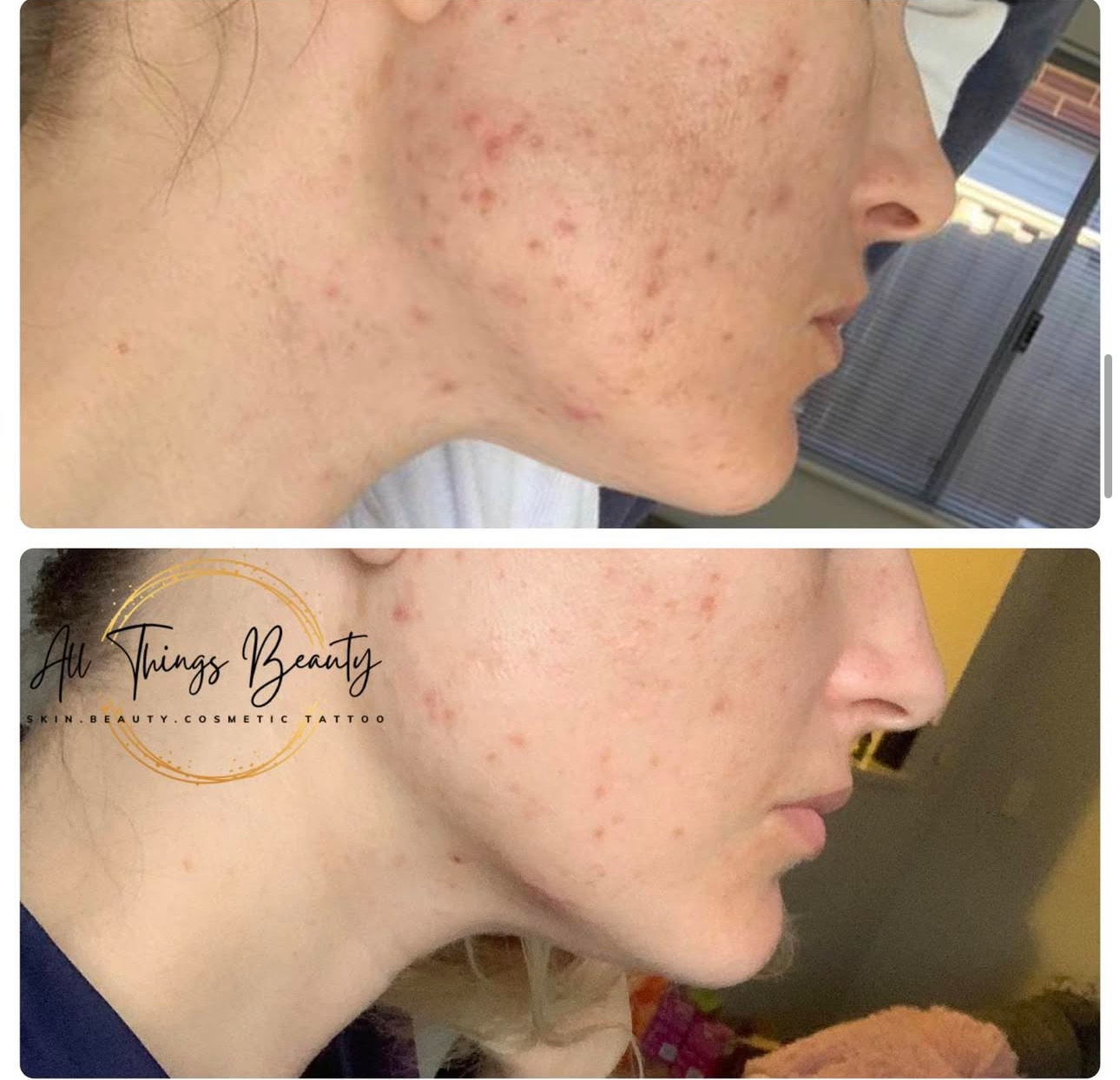 Before and after — Acne